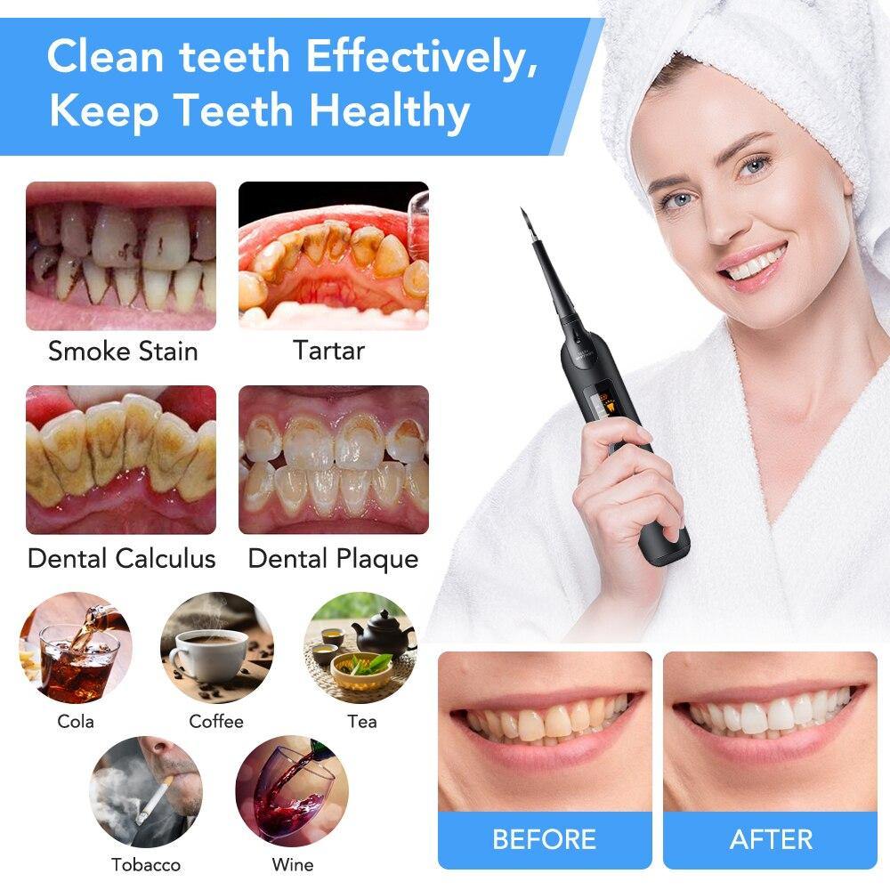 Portable Tooth Irrigator Electric Sonic Dental Scaler Oral Irrigator Tooth Calculus Remover Rechargeable Dental Teeth Cleaner - MY STORE LIVING